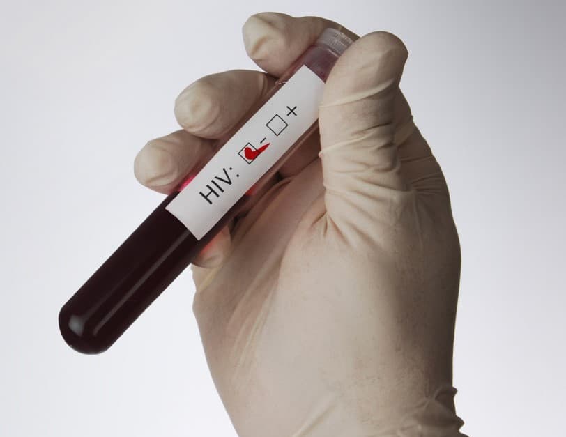 Szlovákiában több helyen lehet ingyenes HIV-tesztet végeztetni