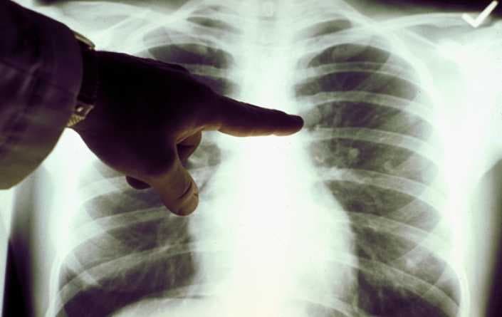 Továbbterjedt a tüdőgyulladást okozó új koronavírus Kínában